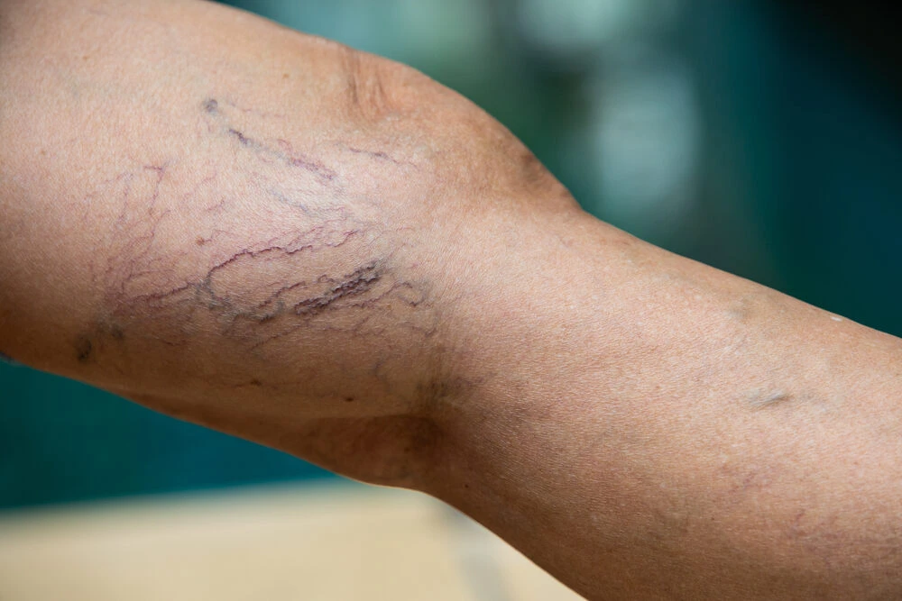 Varicose veins on a leg in Senior women