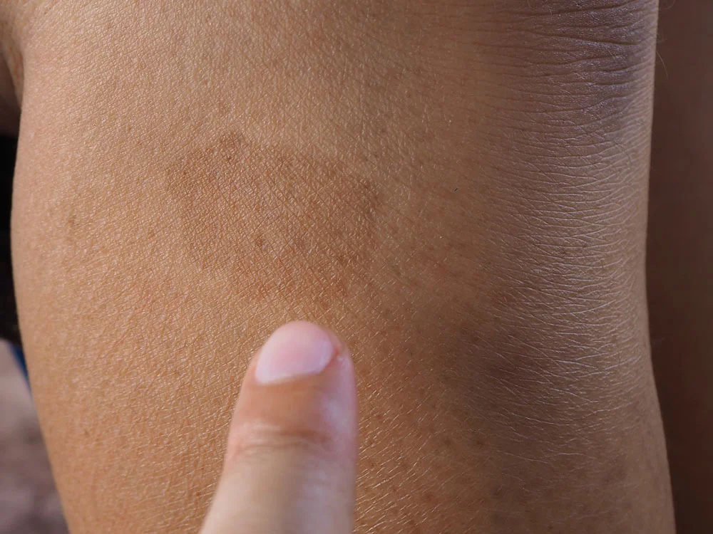 woman finger select focus point to dark brow birthmark or cafe au lait