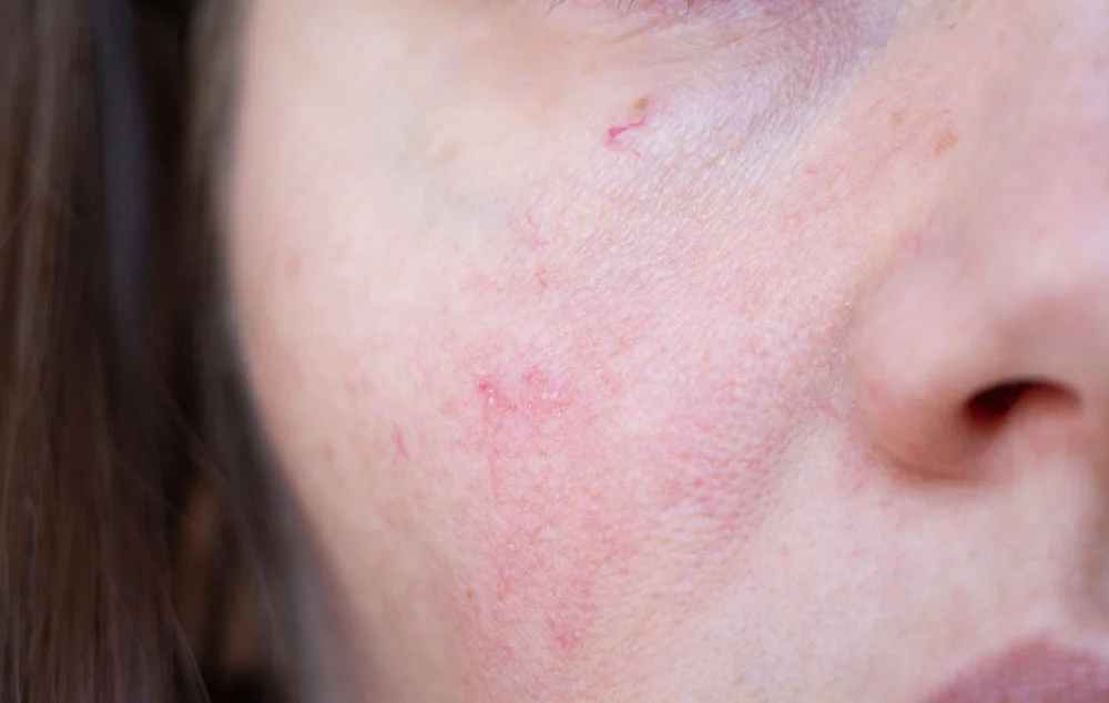 the girl has red capillaries on her face