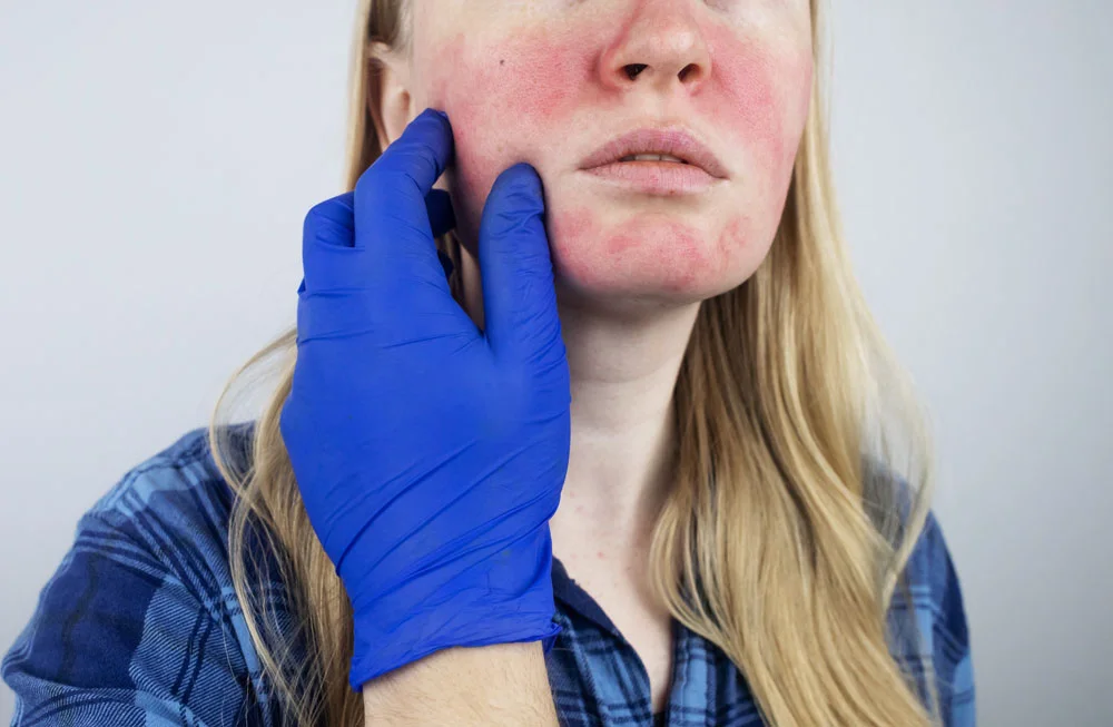 Rosacea face.