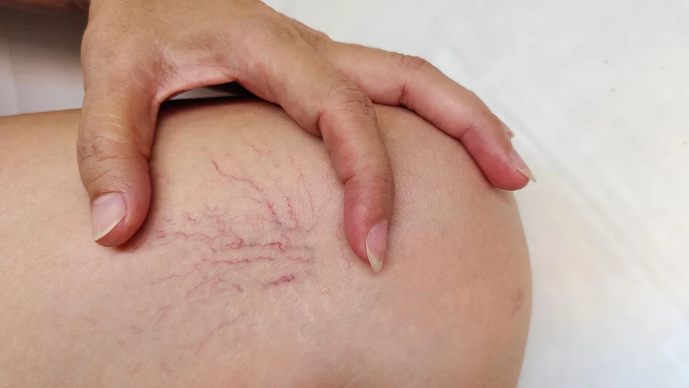 portrait the hand holding the varicose veins