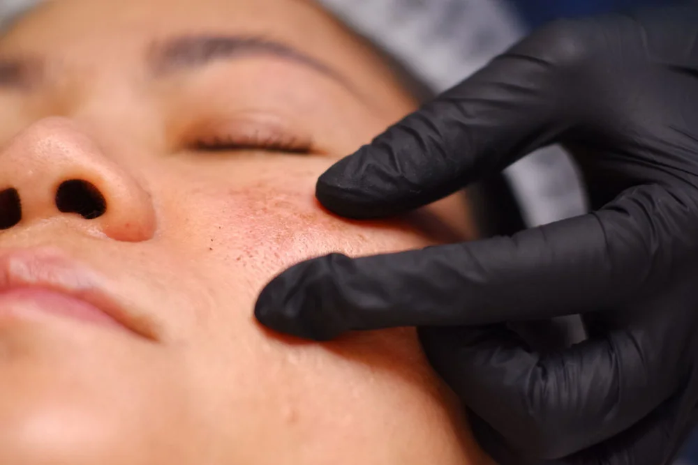 Beauty career, experts, beauticians, doctors, beauticians, providing services for cauterizing freckles, melasma, raised freckles, skin freckles on the face, cauterizing with laser and plasma.