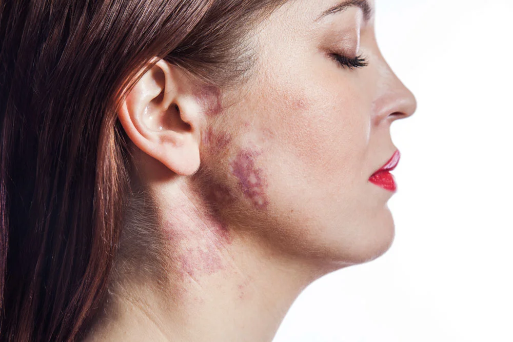 Beautiful woman with real port-wine stain