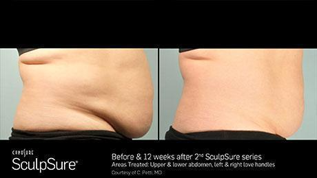 sculpsure