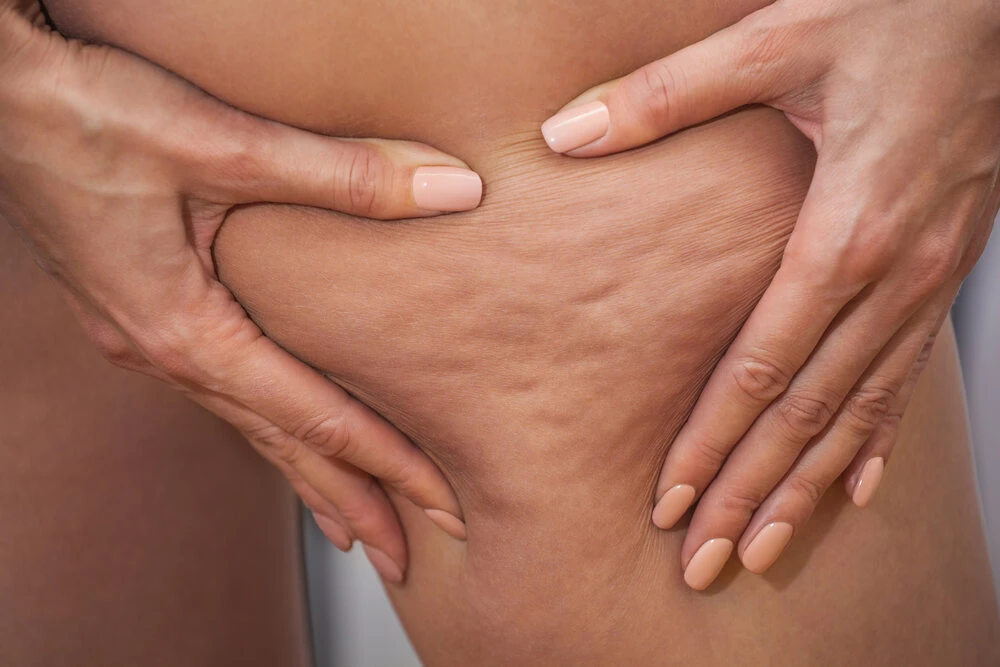 Treatment and disposal of excess weight, the deposition of subcutaneous fat tissue