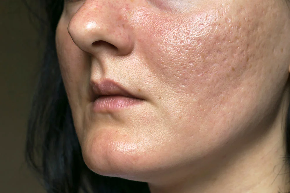 Woman with problematic skin and acne scars.