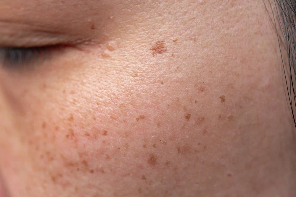 Freckles Over Asian Woman Face