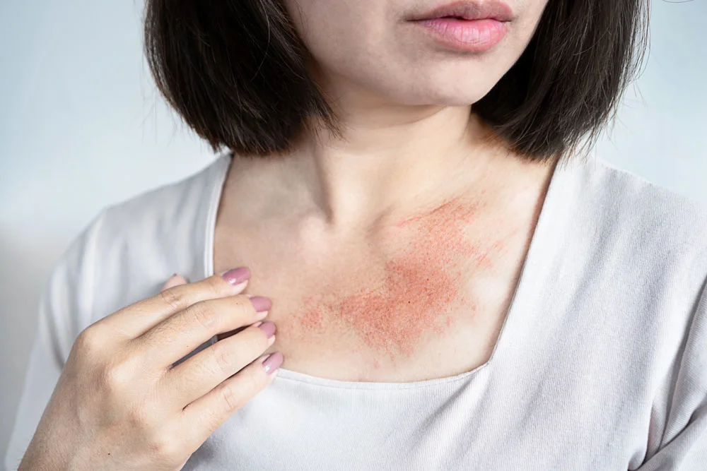 close-up of a woman with a rash and red
