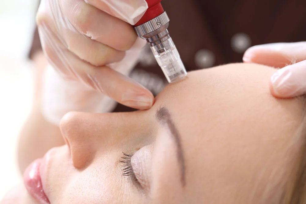 Microneedle mesotherapy, treatment woman at the beautician